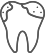 虫歯